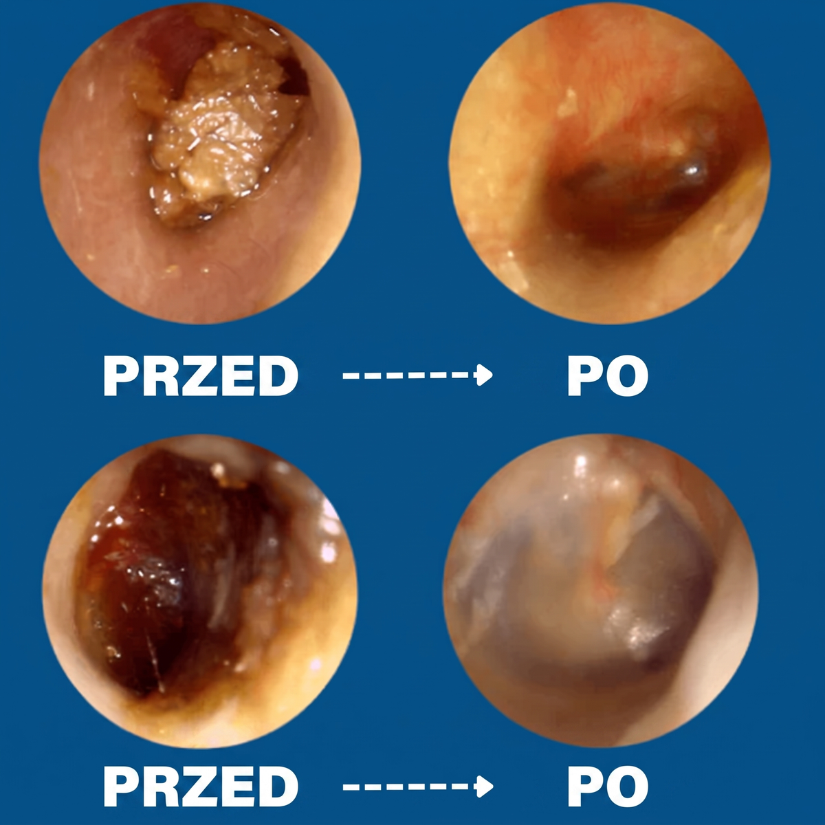Otoskop z kamerą do czyszczenia uszu - EarWax